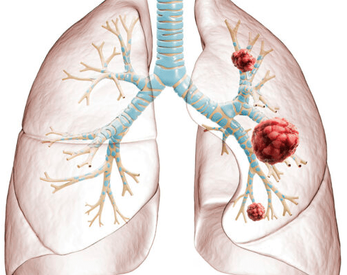 AI may predict spread of lung cancer to brain